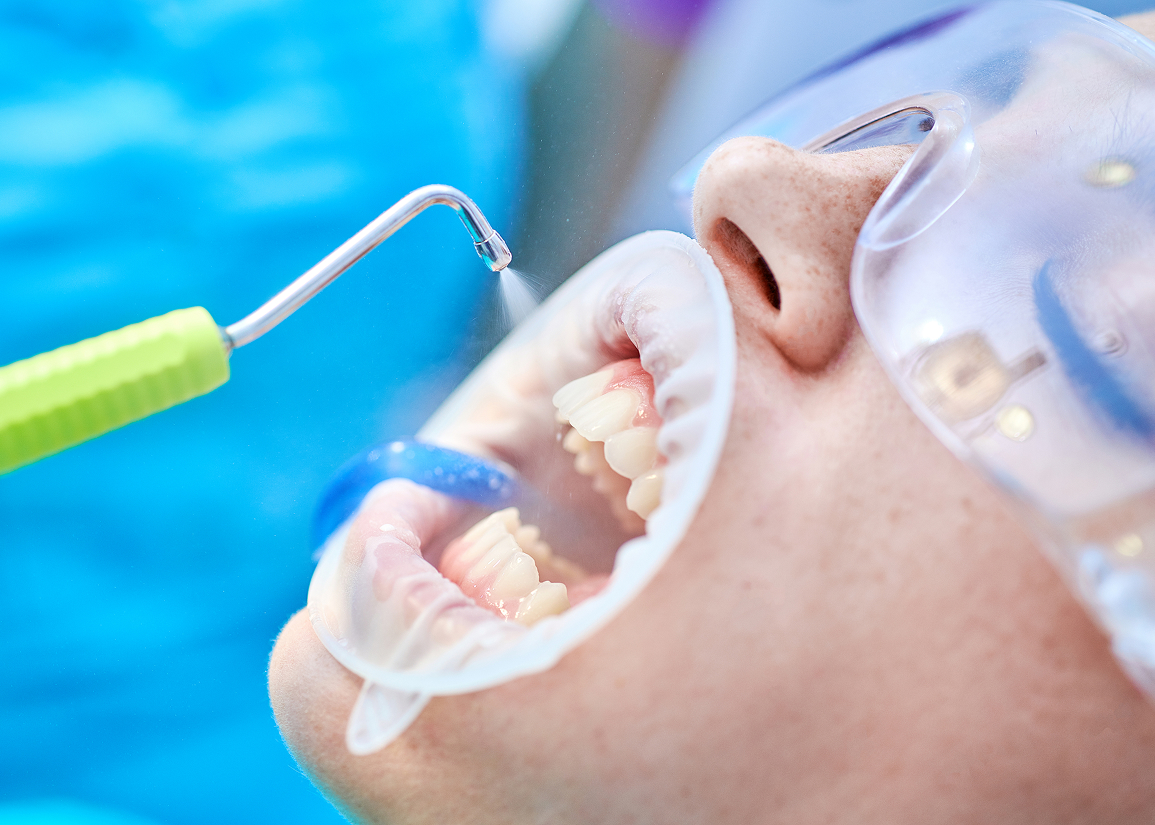 Benefits of air abrasion in dentistry