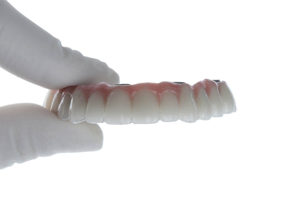 All-on-X dental implants overview