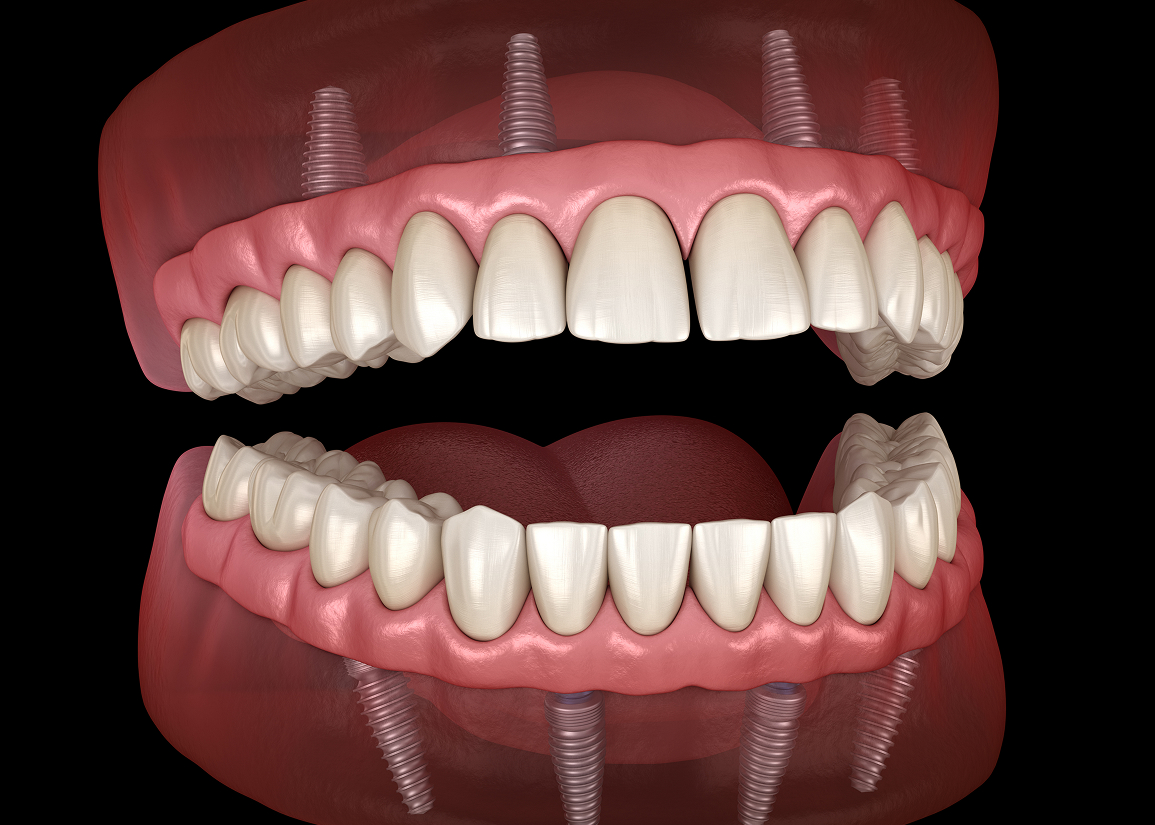 Difference between All-on-X and dentures