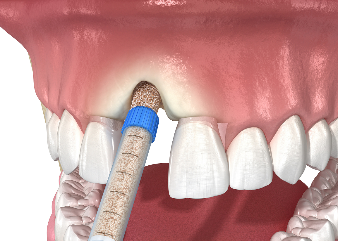 Bone graft for dental restoration