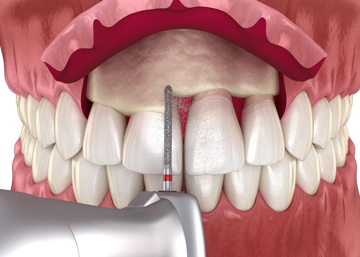 Crown lengthening for restorative or cosmetic reasons