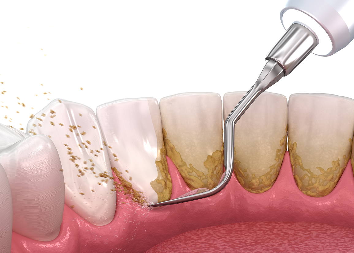 Deep dental cleaning procedure