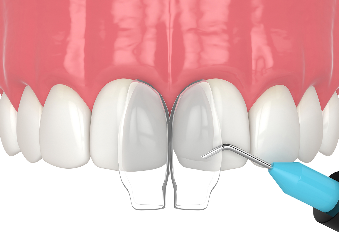 Cosmetic dental bonding overview