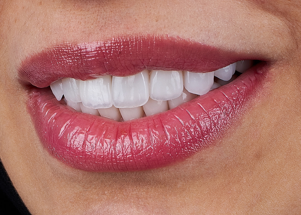 Advantages of cosmetic dental bonding