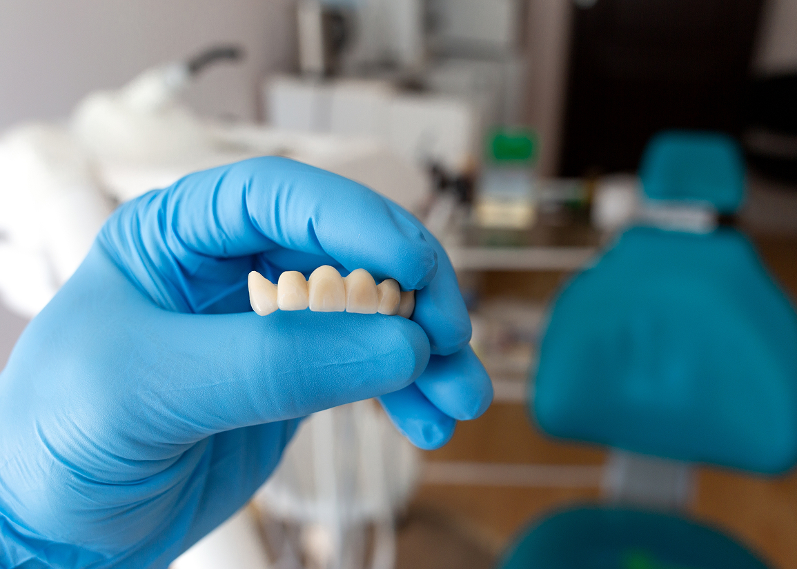Replacing missing teeth with a bridge