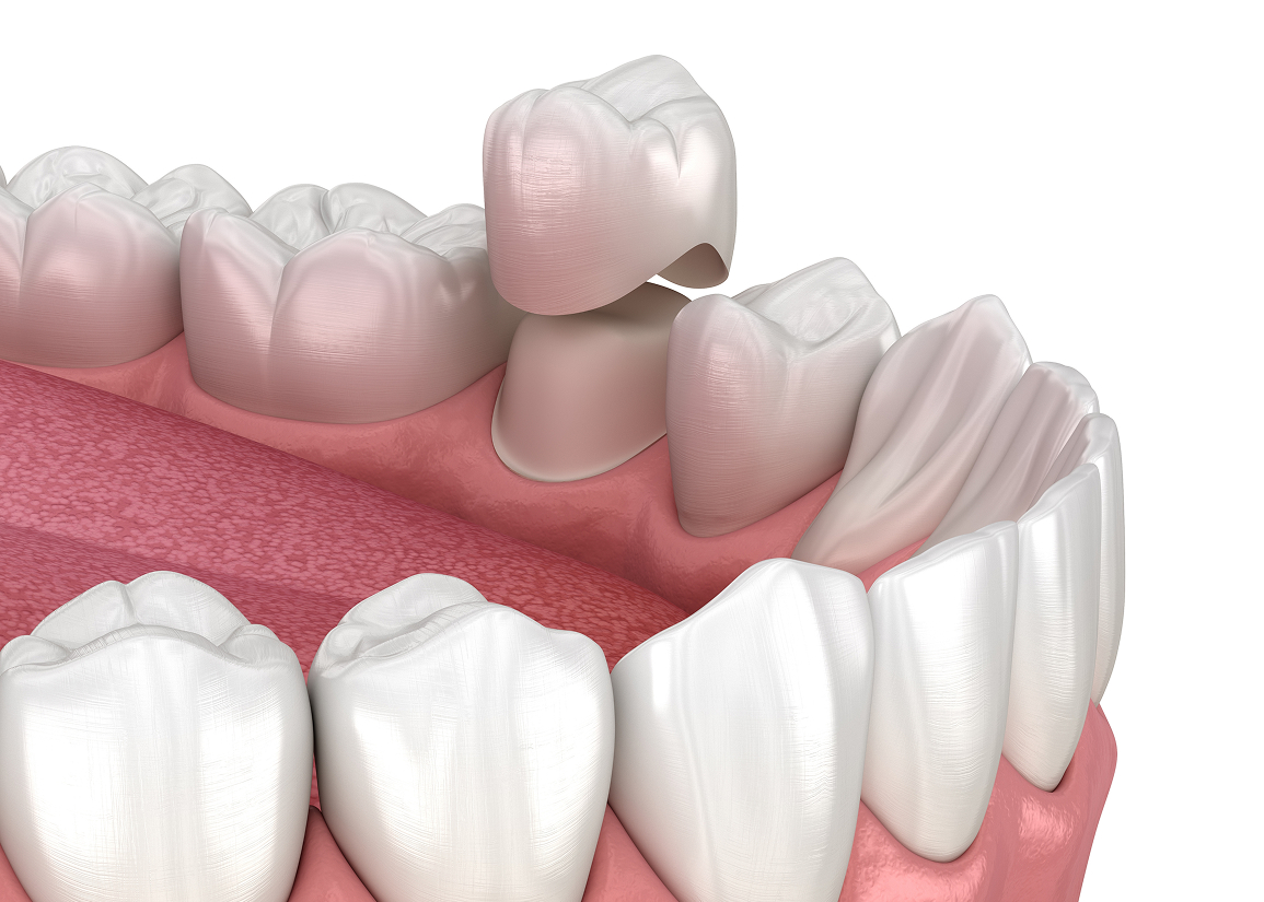 Dental crown restoring a tooth