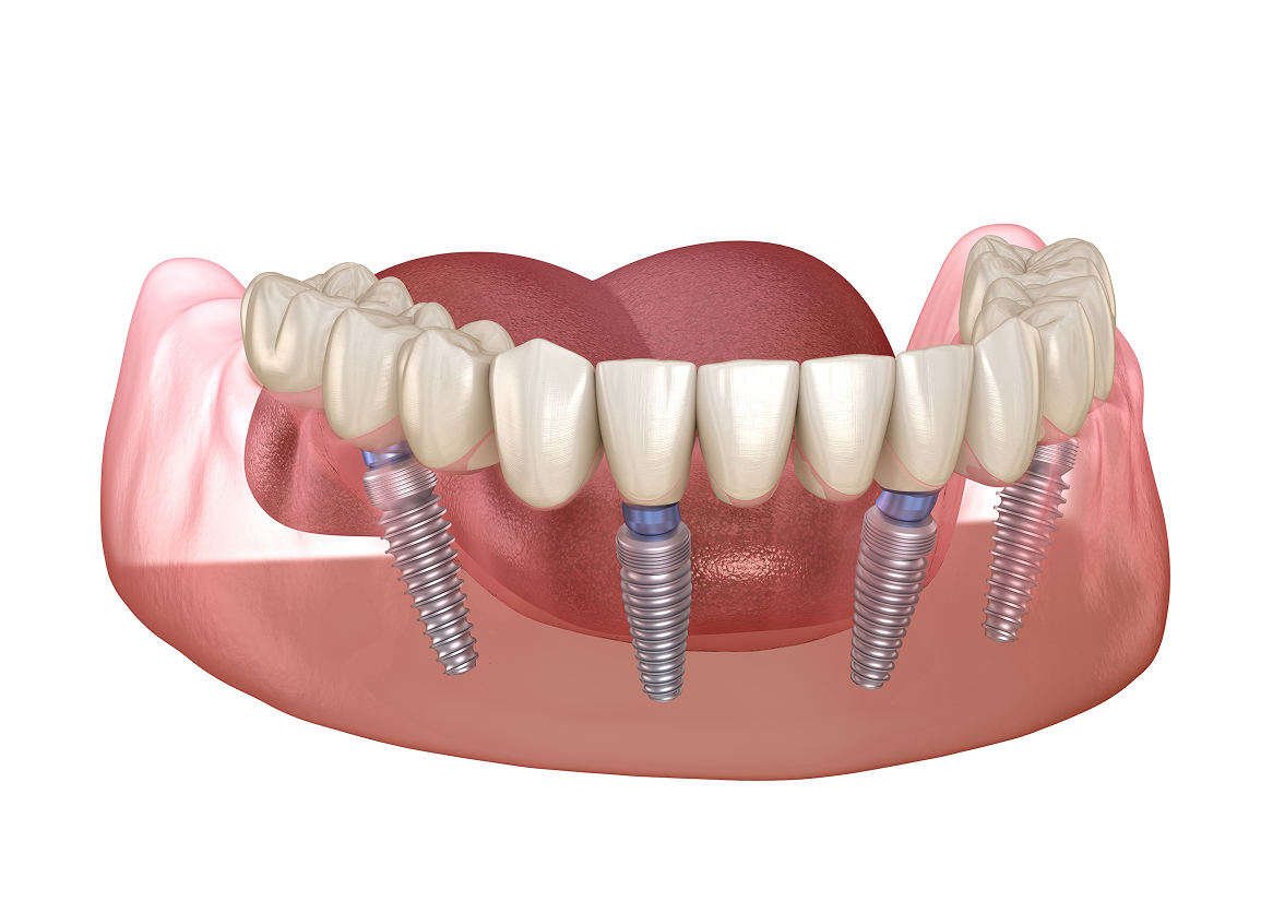 Full-arch dentistry with dental implants