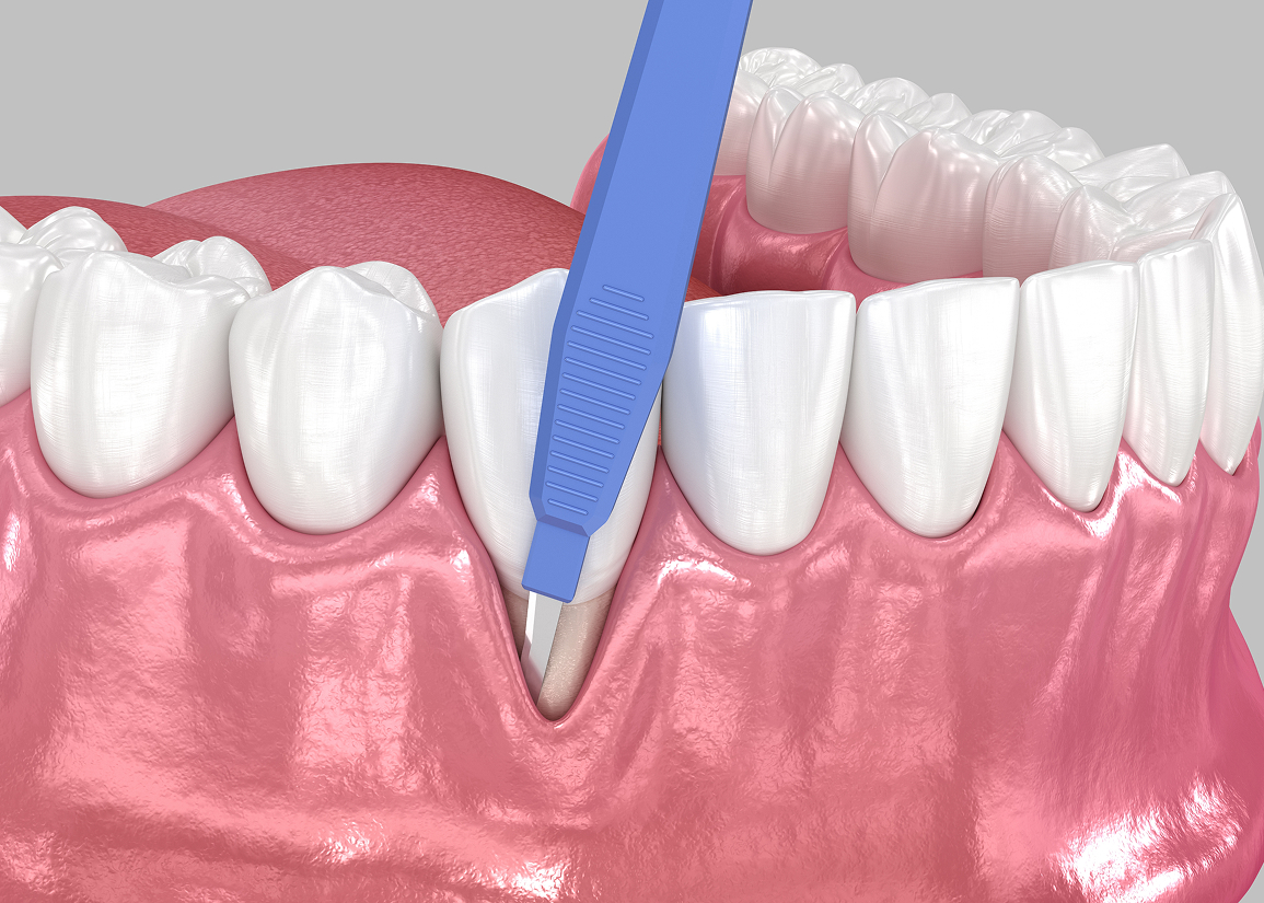 Pinhole Surgical Technique for gum recession