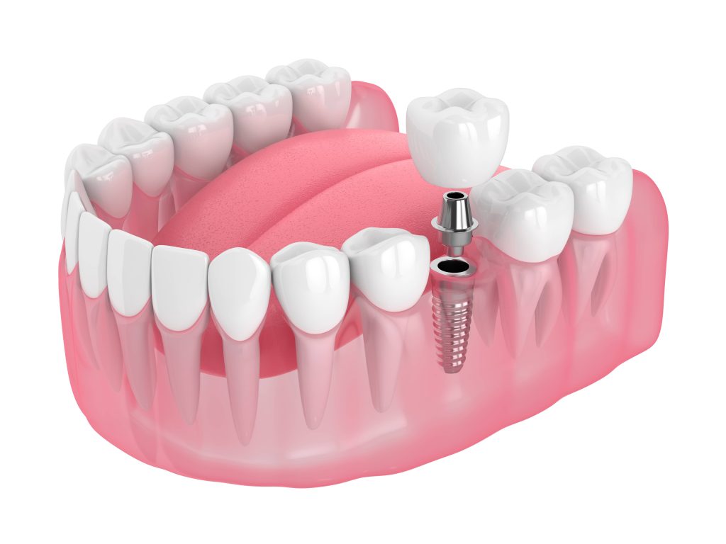 Single Tooth Implants